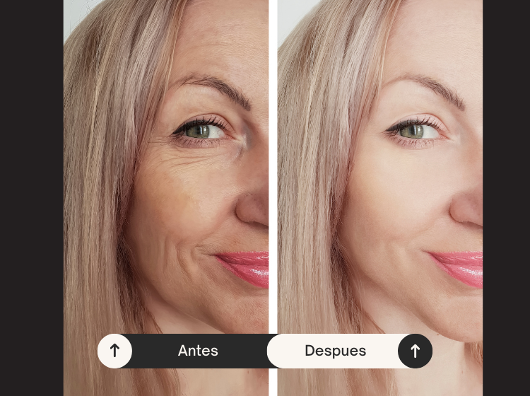 tratamiento rejuvenecedor botox y acido hialuroinico