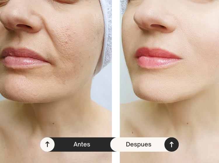 tratamiento rejuvenecedor botox y acido hialuroinico