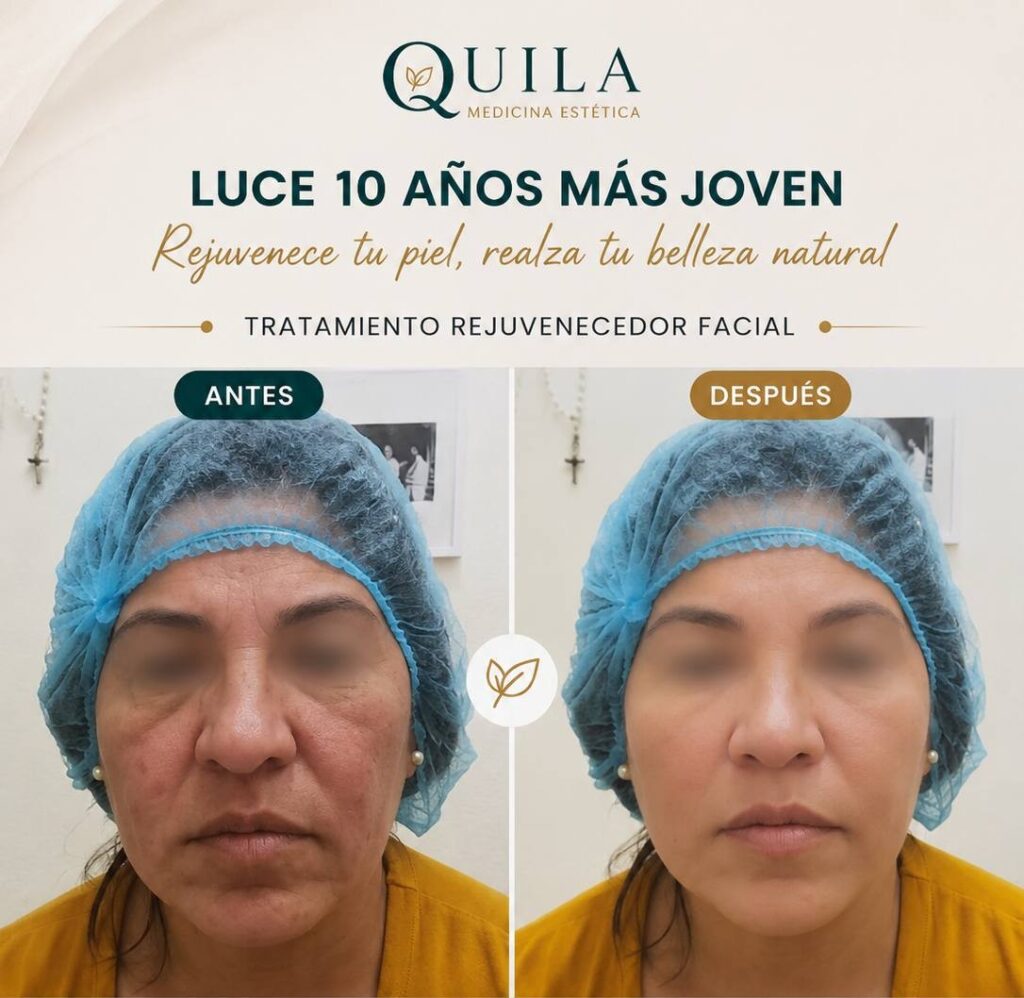 tratamiento rejuvenecedor
